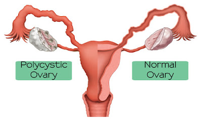 Polycystic Ovarian Diseas, Karuppai noy
