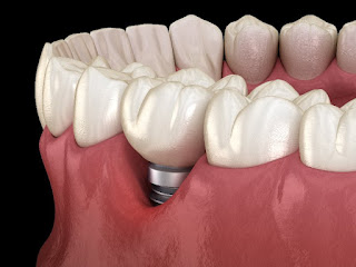 Dental Implant Highland Park Clinic Surgeons Surgery