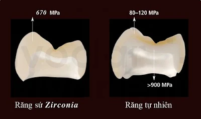 Bọc răng sứ zirconia có bền không?