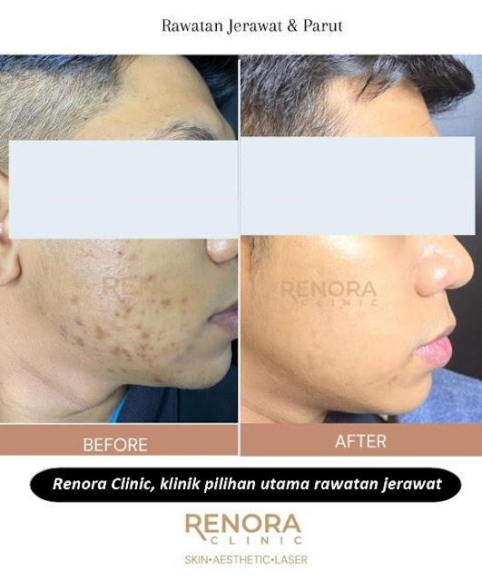 renora clinic klinik pilihan utama rawatan jerawat