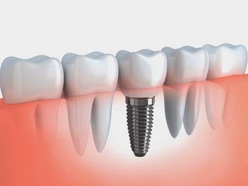  Akció - Cikron korona - Fogászat - Budapest - Hegedűs Dental