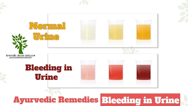 Ayurvedic Remedies for Bleeding in Urine in Hindi