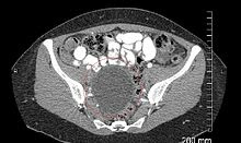 ovarian cysts