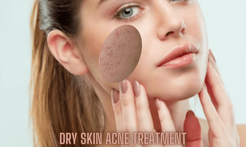 A sad girl have hands o her check with acne scars