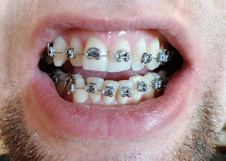 Aparat ortodontyczny efekty