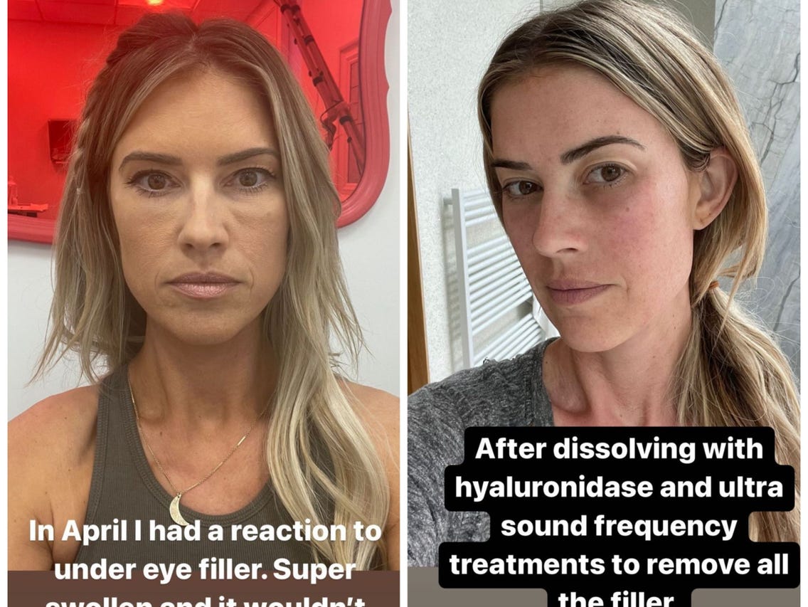 Christina Hall Says She Removed Her Under-Eye Filler After 'Inflammatory Reaction': 'Never Again'