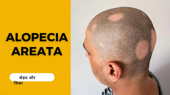 एलोपिसिया एरिटा – Alopecia Areata can cause Baldness