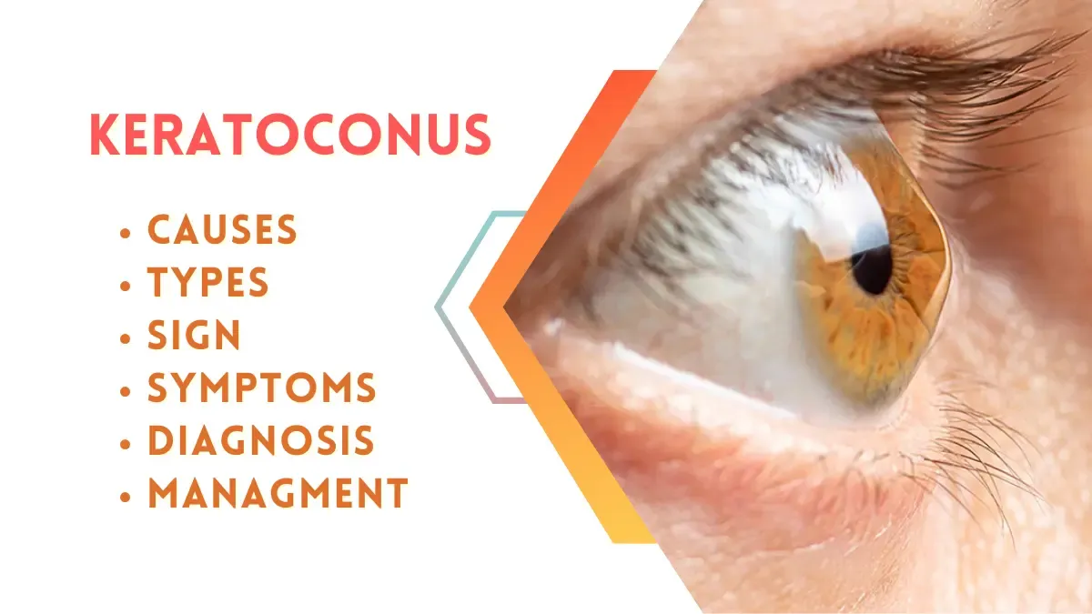 Keratoconus