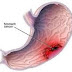 Cara Mengobati Lambung Berlubang Dengan QNC