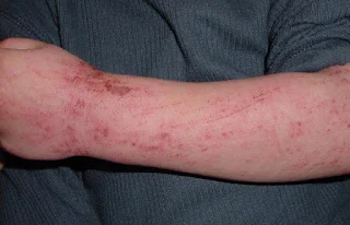 Dermatitis Atopik