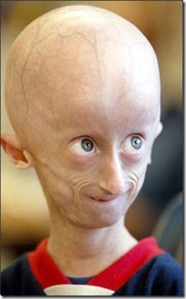 progeria