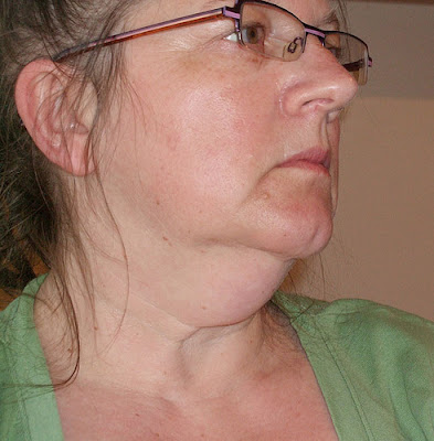 Sagging Jowls and Double Chins