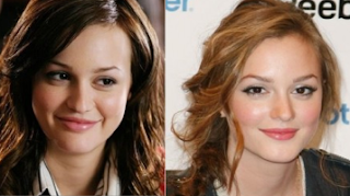 LeightonMeester-before-after-nosejobs23.png