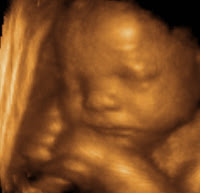 3d Ultrasound Pictures4