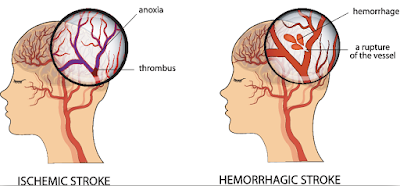 stroke treatment chennai