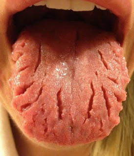 Tongue Cancer Pictures