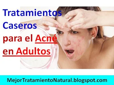 tratamientos-caseros-para-el-acne-en-adultos-remedios-naturales