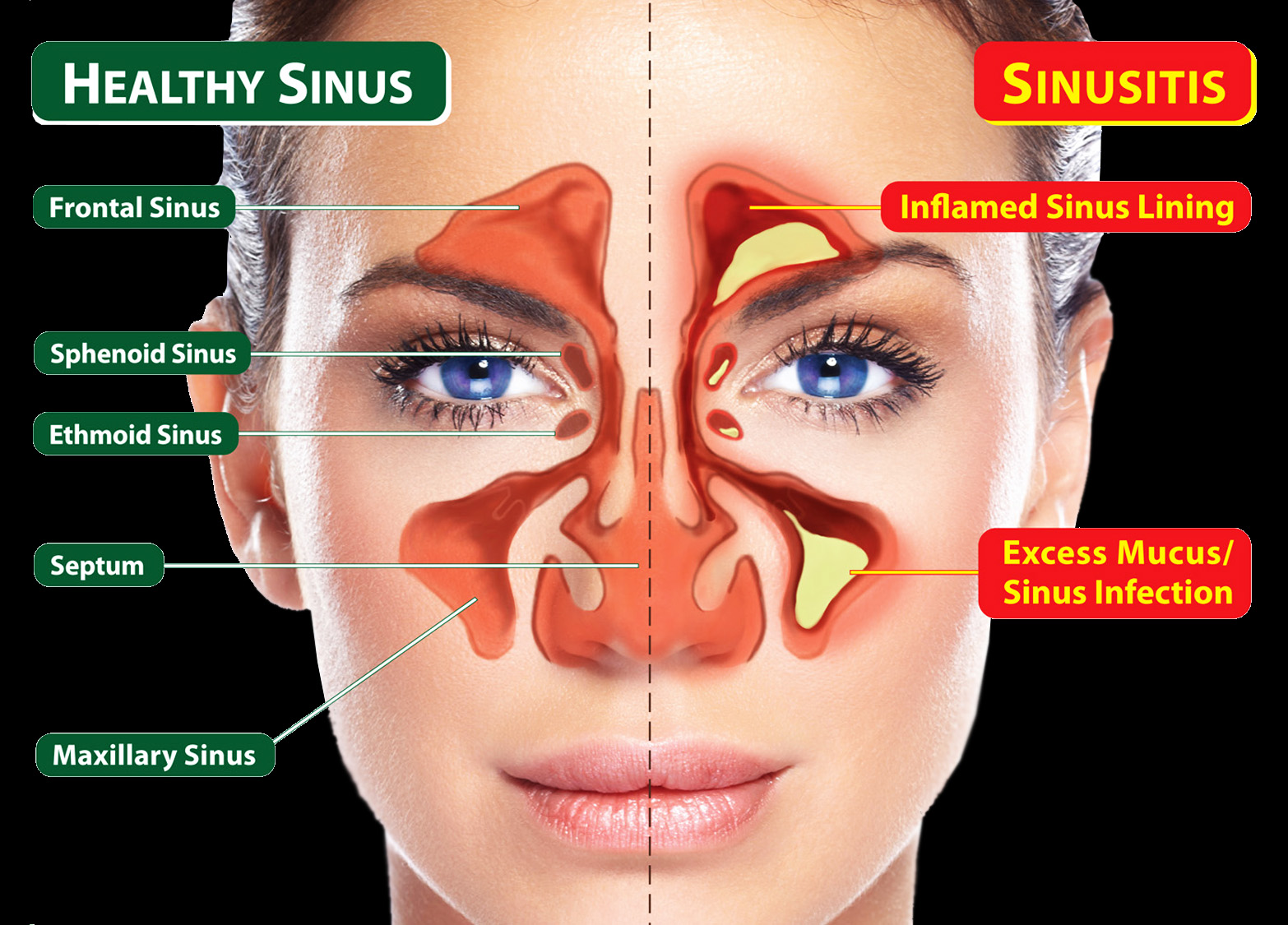 Thymos Anti Sinus/Nasal Allergies Spray Pulihkan Resdung Aku!