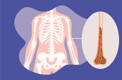 Osteoporosis (pengeroposan tulang)