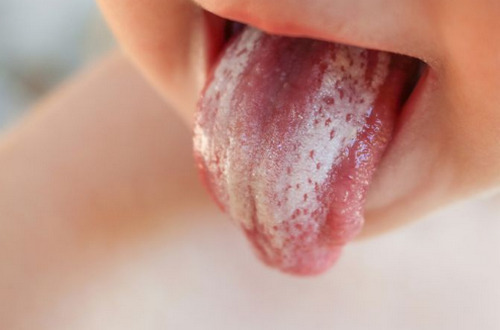 Cara Membersihkan Lidah Bayi yang Putih Karena Susu Formula