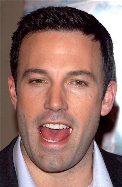Ben Affleck Hair Transplant pic