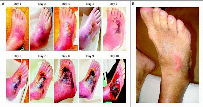 Pengelolaan Kaki Diabetes