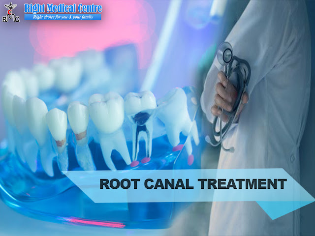 root canal treatment