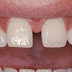 Bị thưa răng khắc phục như thế nào hiệu quả?