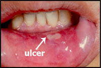 Mouth Ulcer Treatment Using Home Remedies