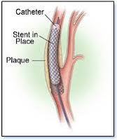 pemasangan cincin stent jantung, Blog Keperawatan