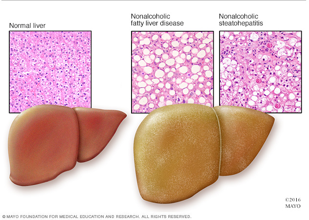 Komplikasi Diabetes Fatty Liver (Sumber Gambar: Mayo Clinic)