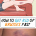 How to Get Rid of Bruises Fast with Natural Home Remedies