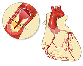 Ischemic Heart Disease