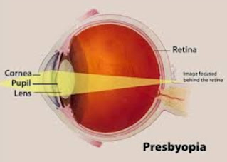What is Presbyopia ?