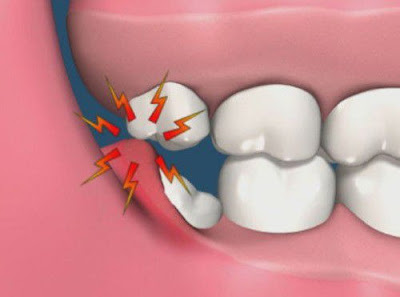 Vì sao lợi sưng và có mủ tái phát nhiều lần ?