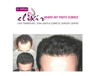 hair transplant center in Islamabad