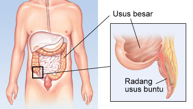 Lokasi usus buntu