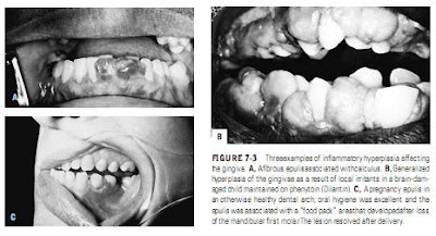 Fibrous Inﬂammatory Hyperplasias and Traumatic Fibromas FIBROMA, EPULIS FISSURATUM, AND PULP POLYP