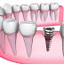 Quy trình thực hiện cấy ghép răng implant