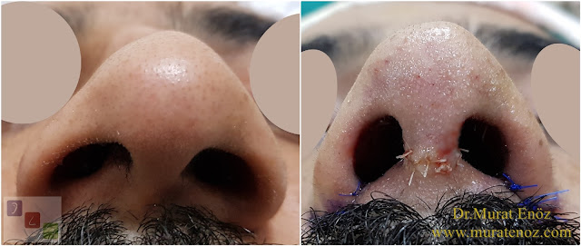 Twisted nose - Crooked nose surgery - Scoliotic nose - Crooked nose - Treatment of twisted nose  -Treatment of crooked nose - Challenges in treatment of deviated nose - Crooked nose aesthetic surgery in Istanbul - Twisted nose treatment in Istanbul
