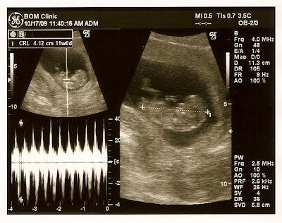 Philips Ultrasonic on The Phillips Family Forum  Ultrasound  3