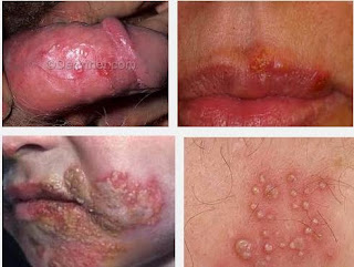 Apakah Penyakit Herpes Bisa Sembuh