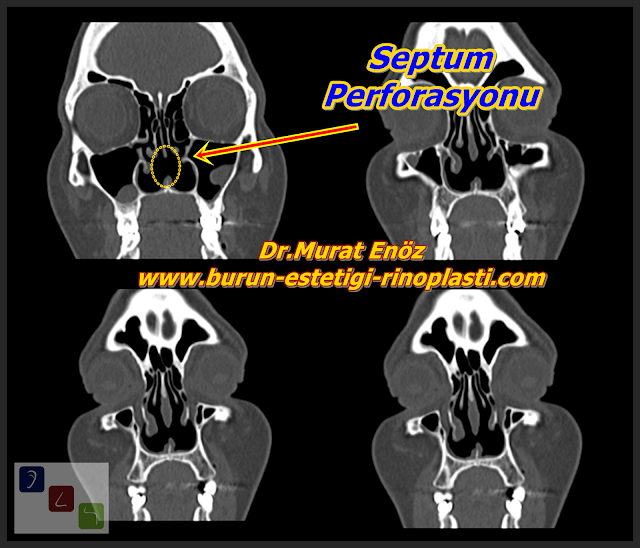 Septum perforasyonu tanımı - Septum perforasyonu  nedenleri - Septum perforasyonu belirtileri - Septum perforasyonu tedavisi - Açık teknik septum perforasyonu ameliyatı - Açık teknik septum perforasyonu onarımı - Burun duvarında delik