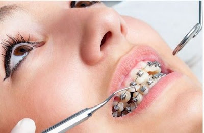 Tác hại của việc niềng răng sai cách bạn chưa biết 2