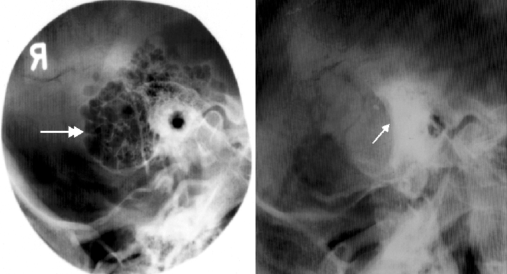 On Radiology Benefits Of Schuller View On Showing Mastoid Bone