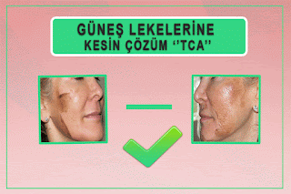 Güneş Lekelerine Kesin Çözüm : TCA