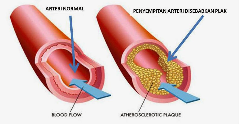 Apa Itu Kolesterol  Blog Perkongsian Info Sihat