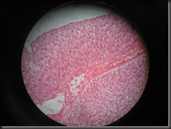 Urothelial ca  high resolution histology slide tsnaps