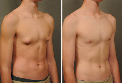 Gynecomastia during puberty