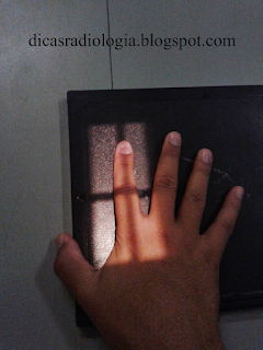 Incidência Radiológica do dedo da mão